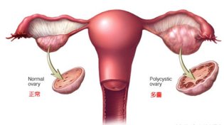 多囊卵巢综合征患者怀孕率低吗 多囊卵巢综合征怎么备孕