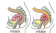 先天子宫后位能受精怀孕吗 先天子宫后位怎么治疗