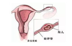 输卵管通而不畅是什么意思 输卵管通而不畅的原因有哪些