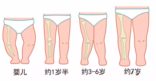 孩子腿外翻需要绑腿吗 给孩子绑腿会不会有什么影响