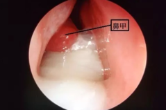 清鼻涕黄鼻涕颜色不同是为什么 清鼻涕黄鼻涕的区别