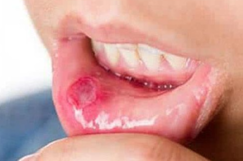 儿童口腔溃疡和便秘有关吗 导致儿童口腔溃疡的因素