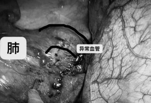 七岁男孩反复肺炎经检查多长了一个肺 胎儿隔离肺诊断