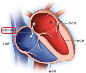 卵圆孔未闭合是什么意思 卵圆孔未闭合有什么影响